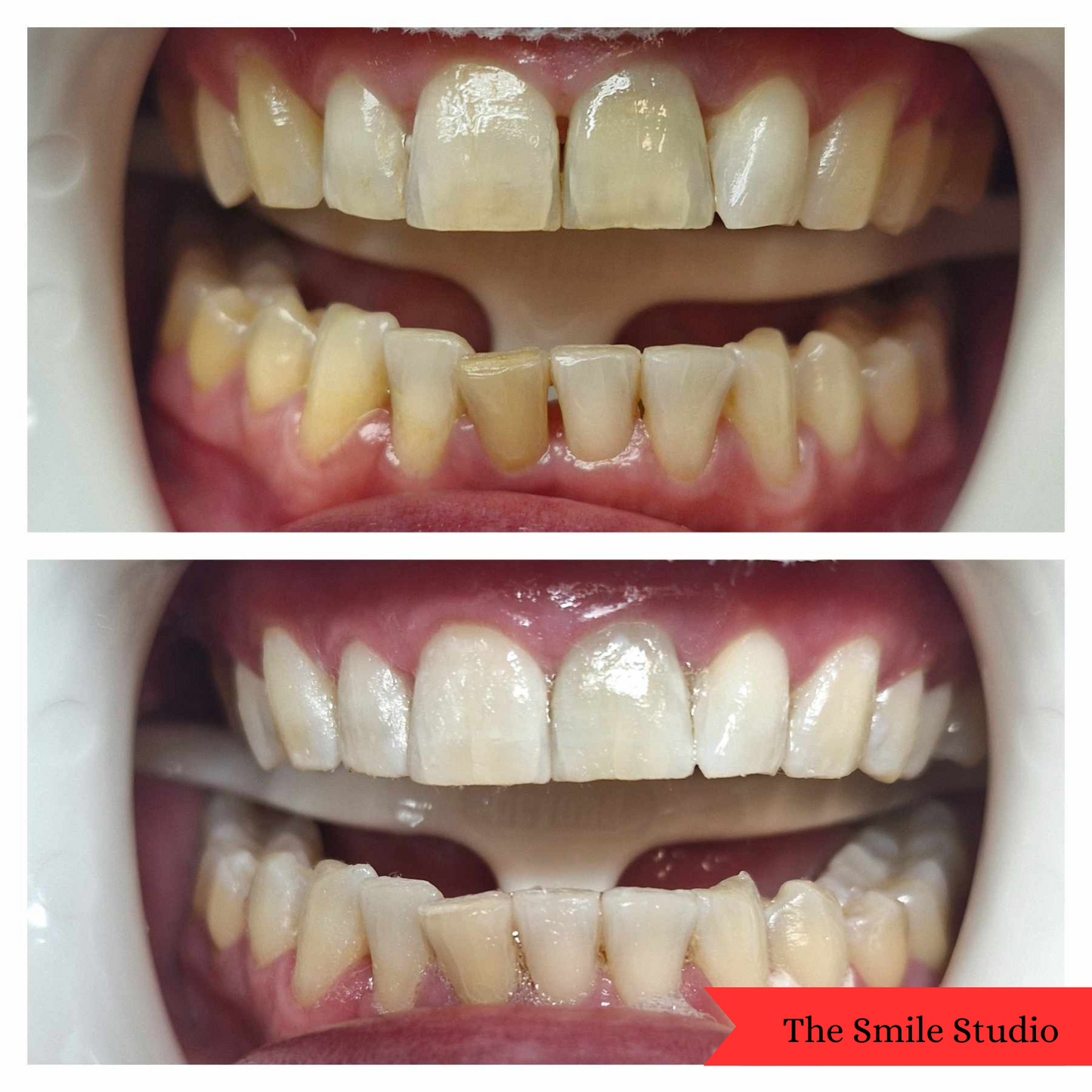 Premium Teeth Whitening Powder