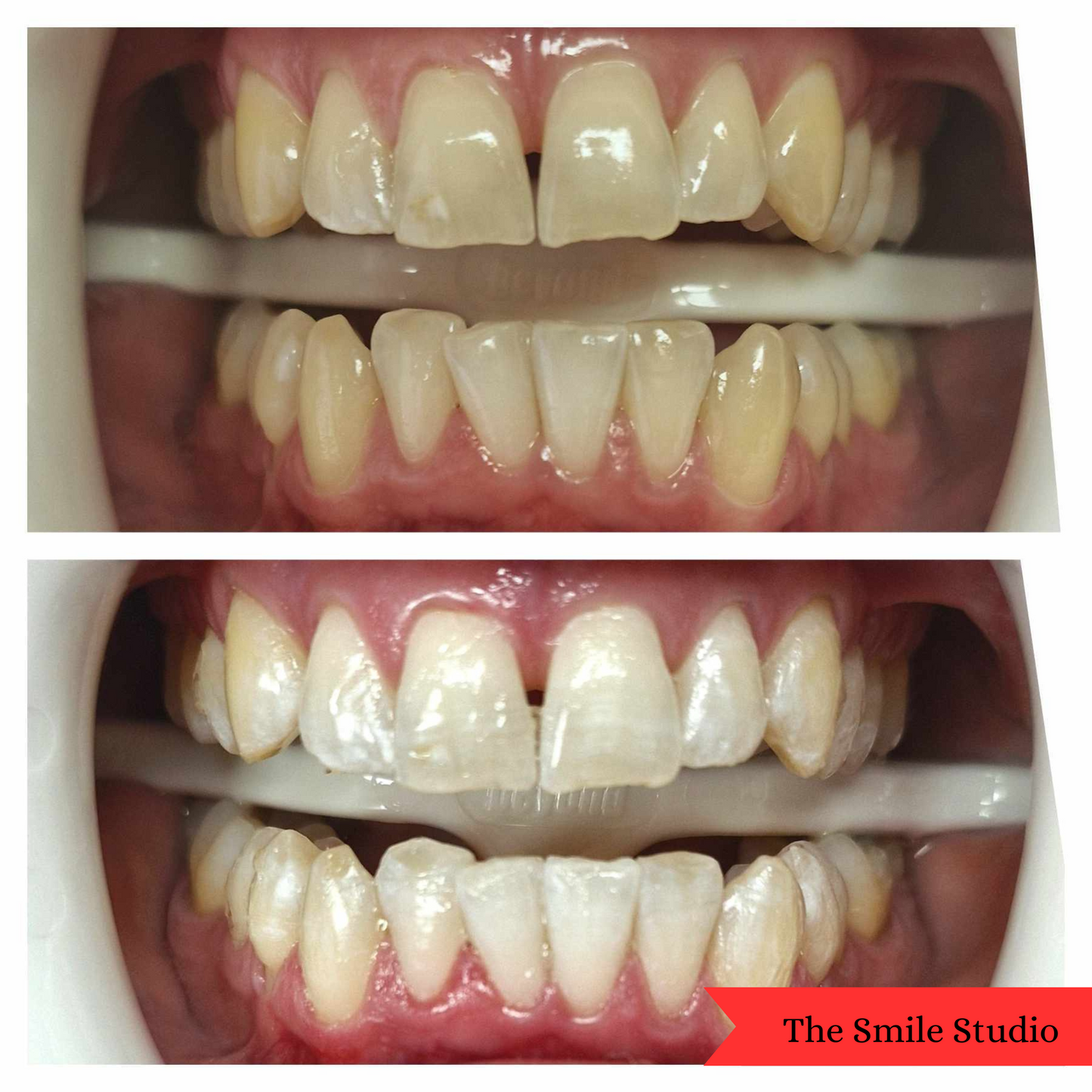Premium Teeth Whitening Powder