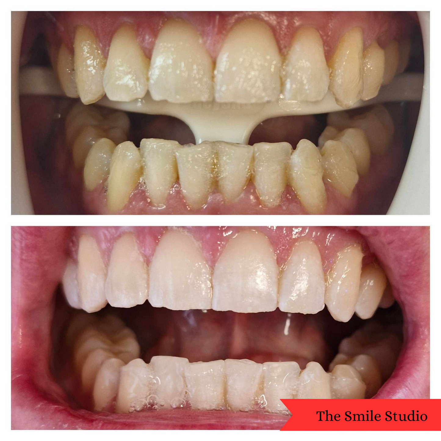 Premium Teeth Whitening Powder